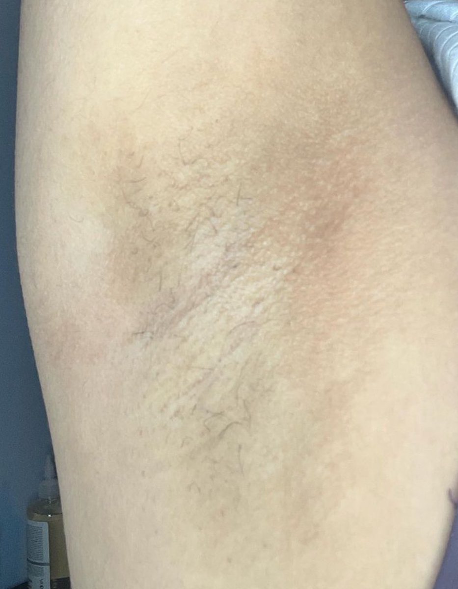 skinwithdaisy's tweet photo. before and after of both my underarm waxings i did on myself 😍 since i started waxing, my hair grows back thinner, and slower, and my underarms have brightened up so much since it’s a next level exfoliation so it removes the dead skin cells. https://t.co/A6WSfu9yGb