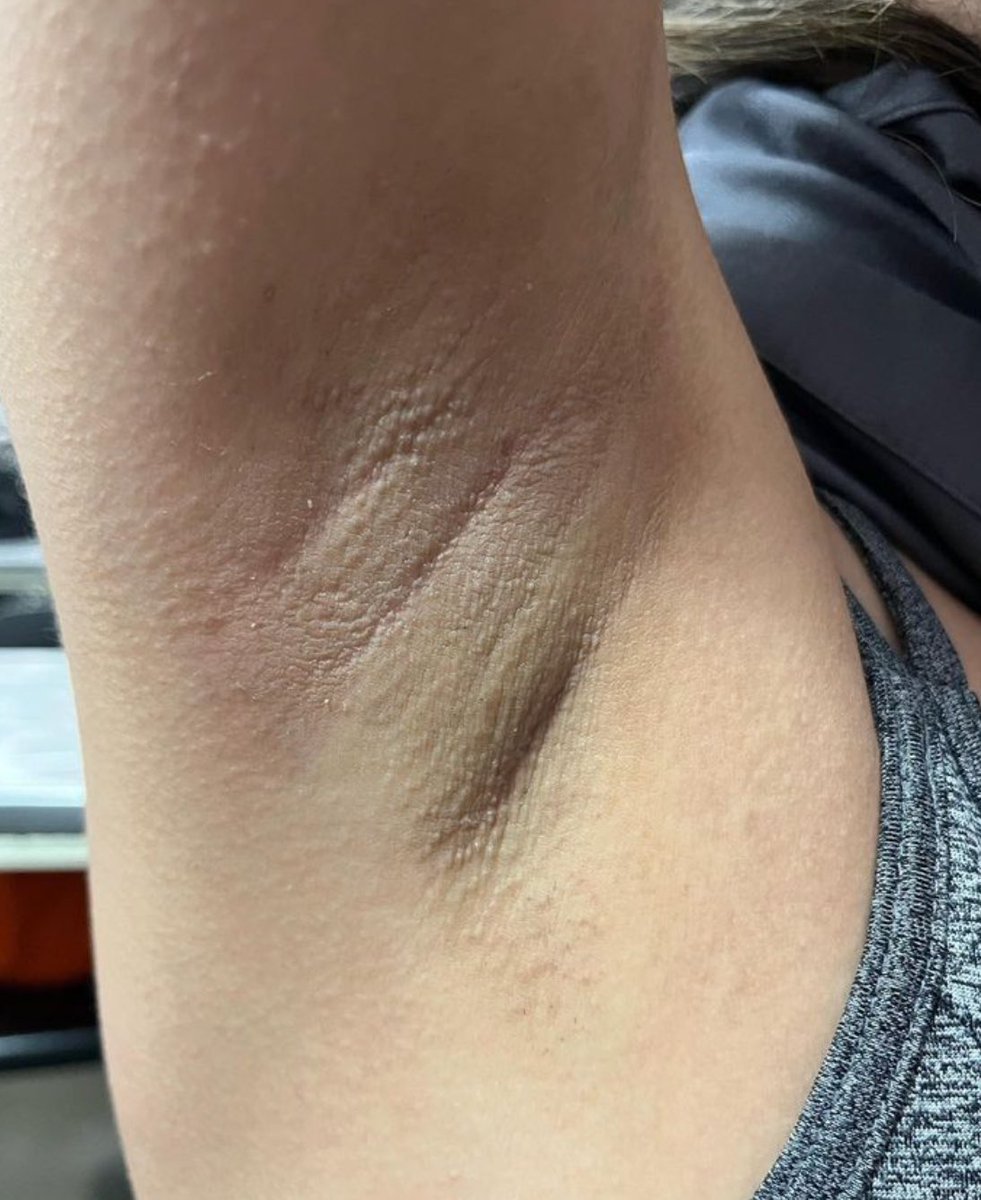 skinwithdaisy's tweet photo. absolute fav of mine i love doing underarm waxes! this one is on miss jeidy 🤩 book your appointment now! https://t.co/ZbtaOgnRub