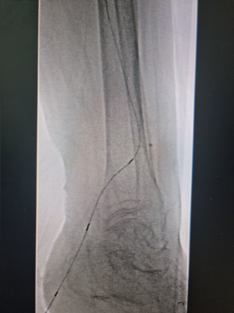 Busy day! Successful retrograde transcollateral recanalization of the peroneal artery to bring flow to the heel! PT kept perforating. #limbsalvage #CLTIfighters #vascularsurgery #IRad #PADed #wires #surgery