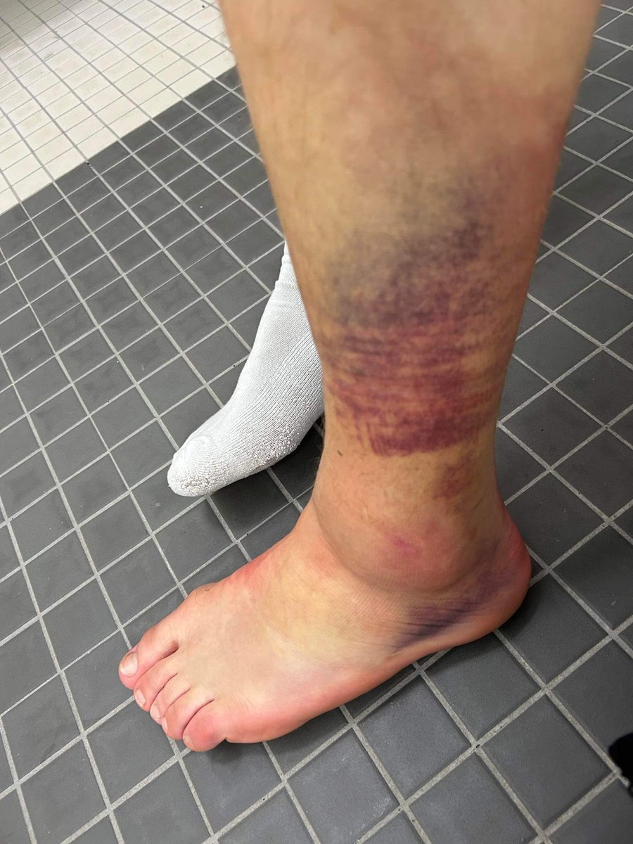 Svona leit ökklinn á Blæ Hinriks fyrir rúmri viku síðan. Helvíti eðlilegt allt saman. #olisdeildin