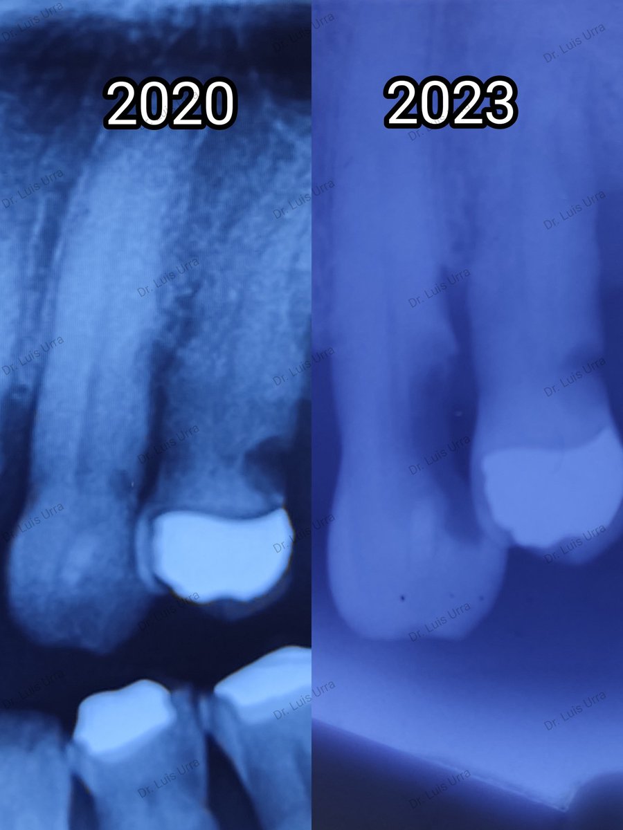 drluisurra's tweet photo. ¿Qué tanto puede avanzar una caries en 3 años? 😳😳😳

Nuestra insistencia de tener una revisión dental cada 6 meses, es para evitar este tipo de situaciones.

Acude con tu dentista periódicamente, no mordemos 😁😁😁
#dentista #odontologia #dentistry #stunningsmile #Irapuato https://t.co/waBwSFlxar