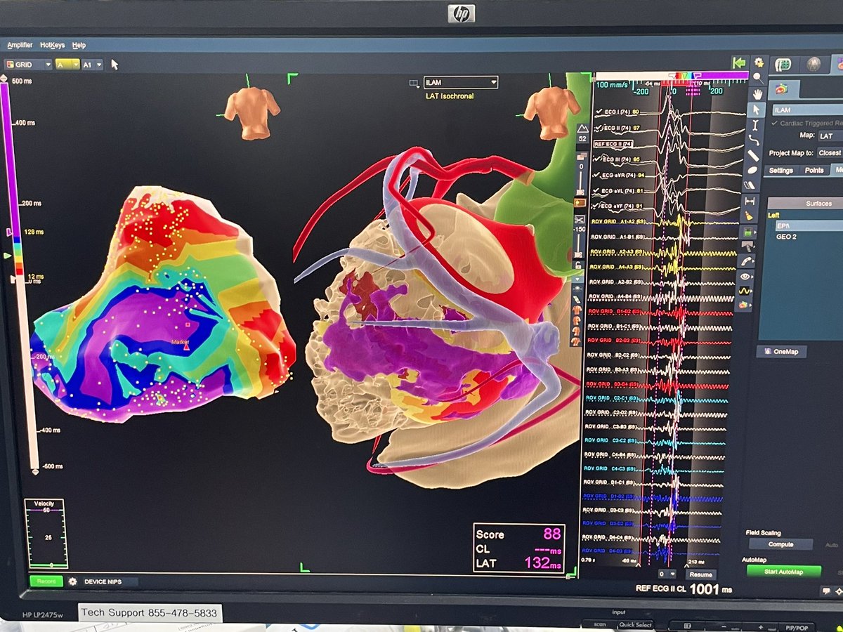 JRWinterfield's tweet photo. Beautiful surgical dissection by @DrZeigler1 and @ct_musc with mapping in OR by @JPayne_EP @DanBLevinMD and @AbbottCardio mapper @AMatthews0 - non inducible at case end. https://t.co/46yYlmId6C