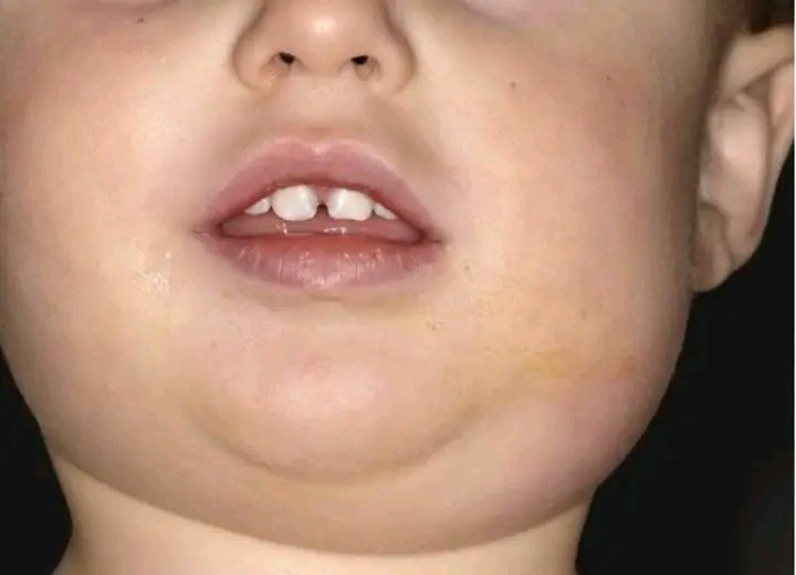 MDNnewss's tweet image. The Health Department has urged the public not to panic over the outbreak of mumps in the country.

#MDNnews