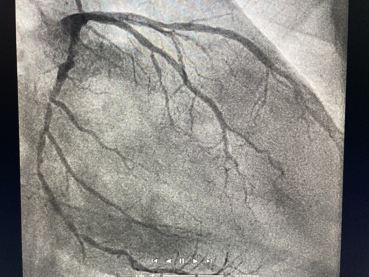 How is it that sometimes one vessel (here: Cx) seems totally destroyed by CAD while others (RIM, LAD) only have mild disease? Smoking, lipids etc should affect all vessels the same way, right? Anybody understand the underlying pathological process?