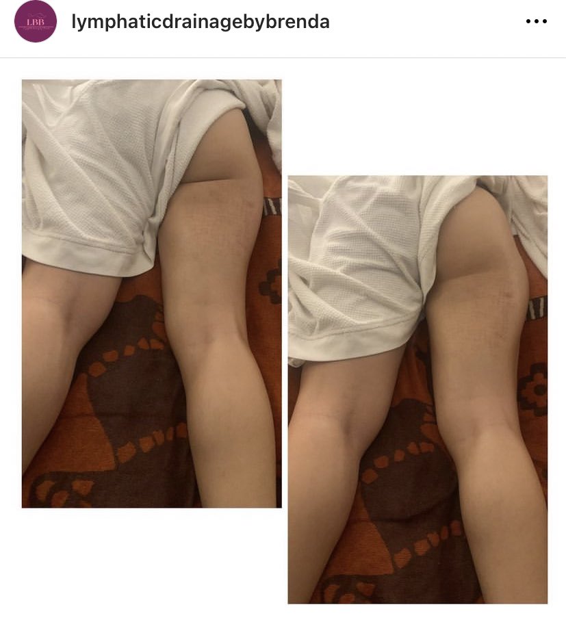 Chukulee_'s tweet photo. Non surgical body sculpting
Detox and weight loss
Manual lymphatic drainage massage
https://t.co/SIK9pLI5GY
#brazillianlymphaticdrainagemassage #lymphaticdrainagemassageinlagos #coloncleanse #detox #weightloss #bodysculpting #bootylift #summer #lagos #vi #curvy https://t.co/vg8nxDhFZK