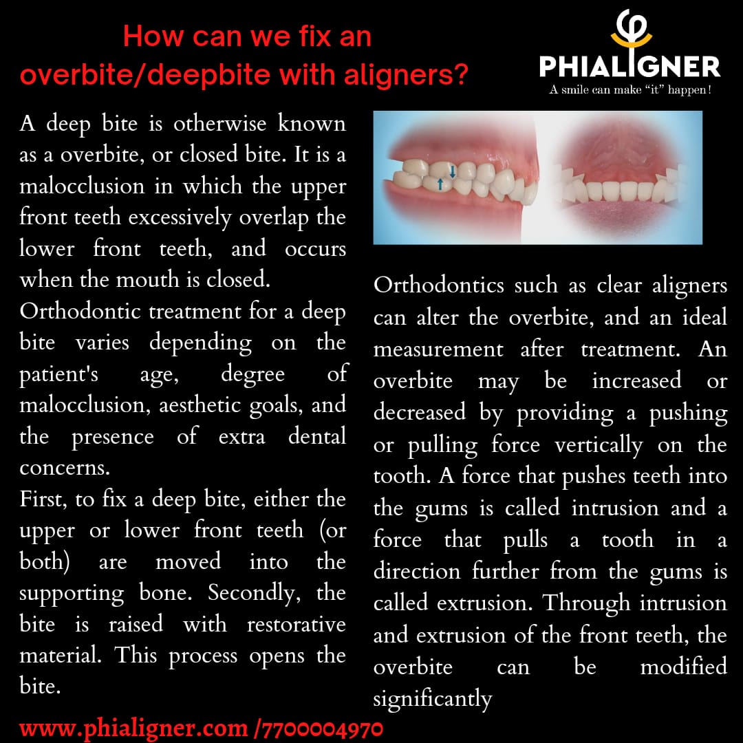 phialigner's tweet image. How can we fix an overbite/deepbite with aligners? 
Often, a deep bite is treated either with braces or clear aligners. Invisible aligners are an option for correcting an overbite without braces.

#openbite #deepbite #overbite #alignerattachment #alignercases #painless