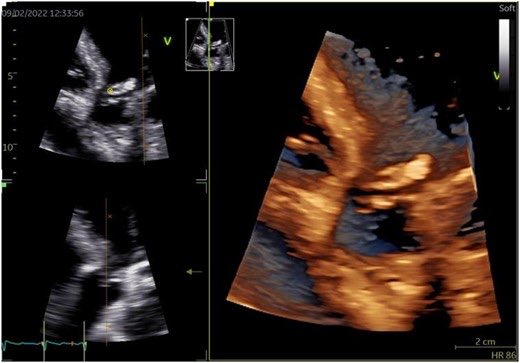 Serginho1409's tweet image. Echocardiography in cardioembolic stroke prevention
doi.org/10.1093/eurhea… #echofirst #prosthesis #thrombus