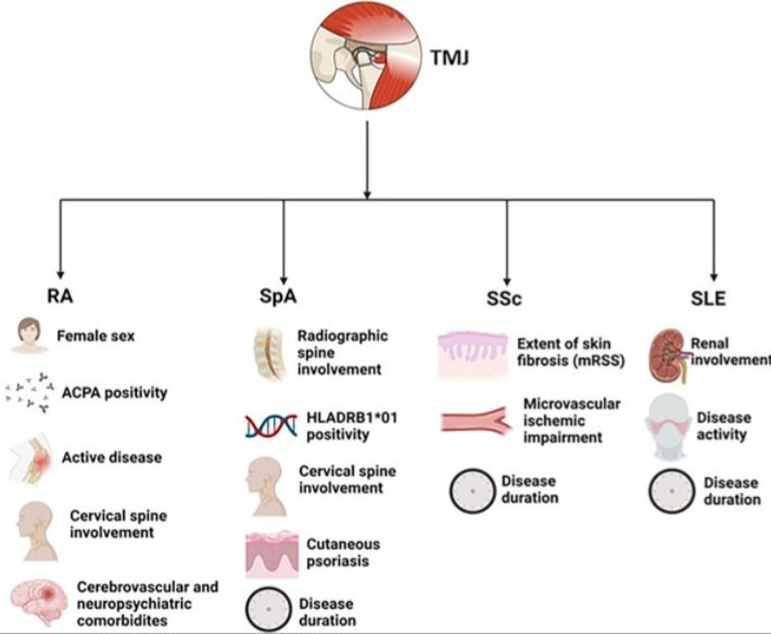 ElvisHysa's tweet photo. Our recent systematic review provides insights into the prevalence and risk factors of temporomandibular disorders in immune-mediated rheumatic diseases. Available online😉 #rheumtwitter #pain #rheumatology #arthritis https://t.co/5xNvLTsbUz @seminarthrheum https://t.co/rvjYfbysHK