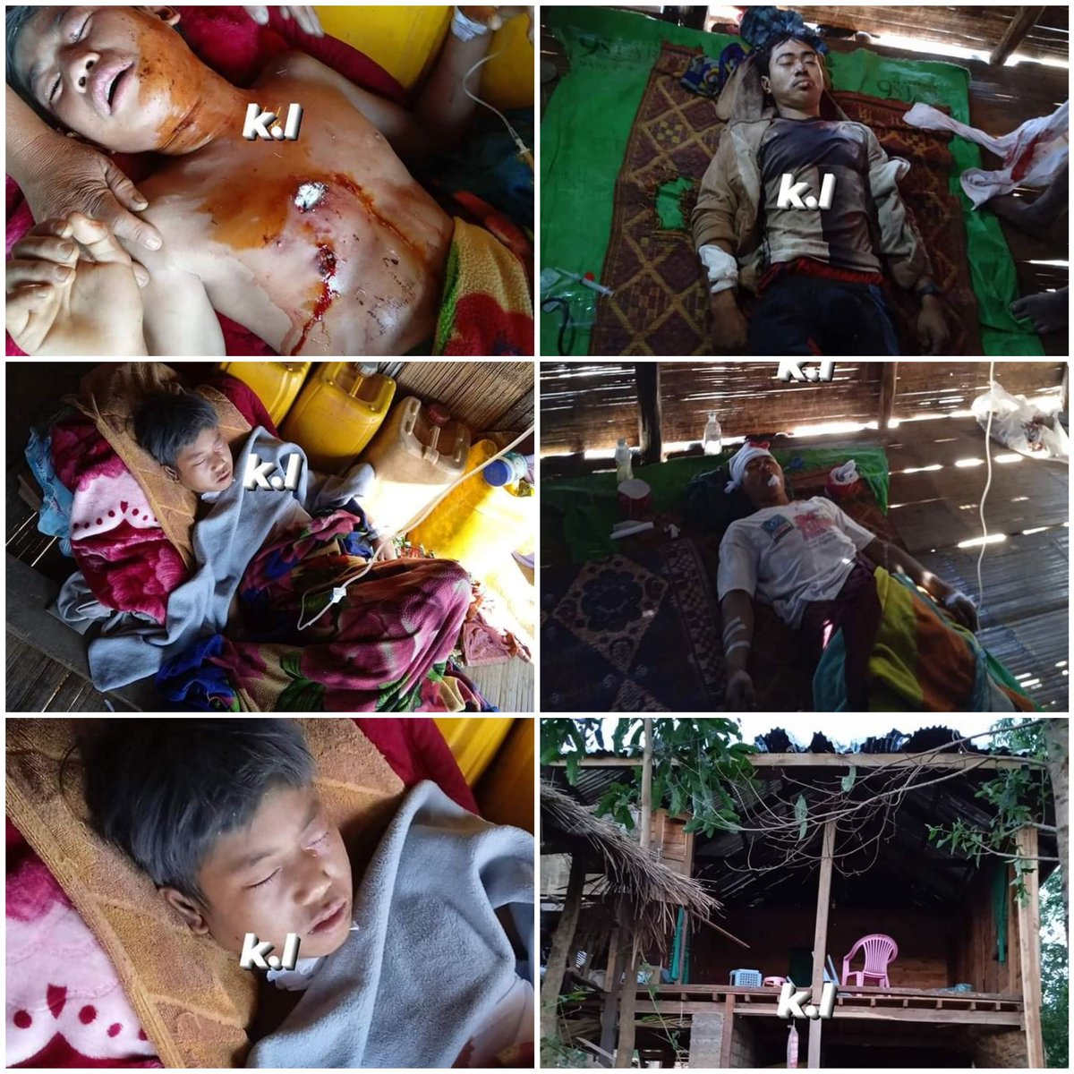 miN13700's tweet photo. 3 civilians, including a teenager, were SERIOUSLY WOUNDED and Catholic church &amp; some civilians' houses were destroyed when military council bombarded a village in southern Shan State's Pekhon tsp with jet fighter at 3.50 am on May 6, amid no fighting.
#2023May6Coup
tw // injuries https://t.co/1X3ef3pKyJ