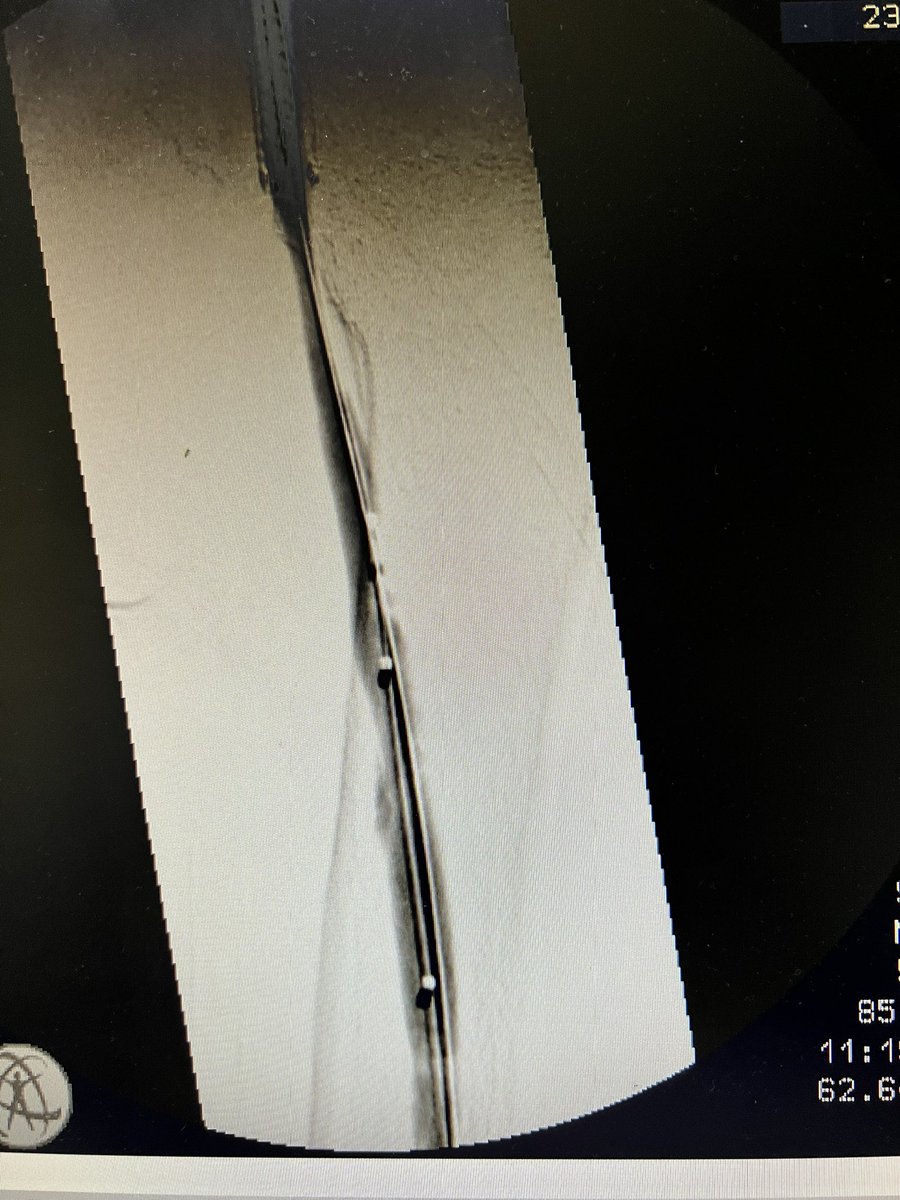 robshahverdyan's tweet photo. Here a case of elsewhere abandoned endoAVF and #BCAVF creation. 2 years later cephalic arch stenosis (SG), occlusion, now subtotal occlusion. Treated with TE, uHPB PTA of whole cephalic vein, &amp; due to significant recoil &amp; residual thrombus/hyperplasia Supera stents. Qa 870ml/min. https://t.co/TwCcvr9LpM