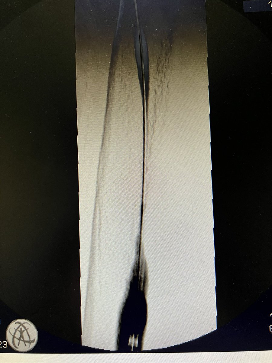 robshahverdyan's tweet photo. Here a case of elsewhere abandoned endoAVF and #BCAVF creation. 2 years later cephalic arch stenosis (SG), occlusion, now subtotal occlusion. Treated with TE, uHPB PTA of whole cephalic vein, &amp; due to significant recoil &amp; residual thrombus/hyperplasia Supera stents. Qa 870ml/min. https://t.co/TwCcvr9LpM