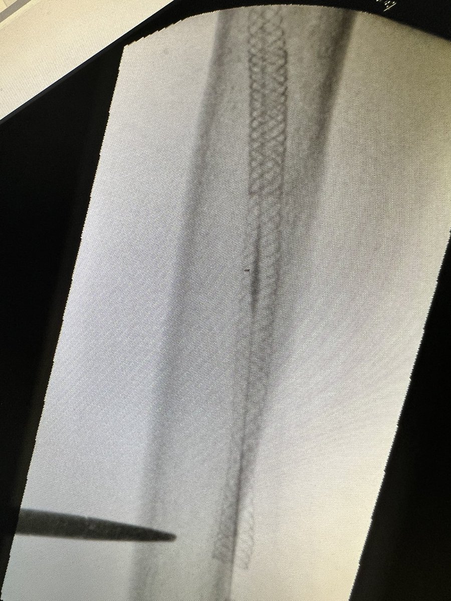 robshahverdyan's tweet photo. Here a case of elsewhere abandoned endoAVF and #BCAVF creation. 2 years later cephalic arch stenosis (SG), occlusion, now subtotal occlusion. Treated with TE, uHPB PTA of whole cephalic vein, &amp; due to significant recoil &amp; residual thrombus/hyperplasia Supera stents. Qa 870ml/min. https://t.co/TwCcvr9LpM