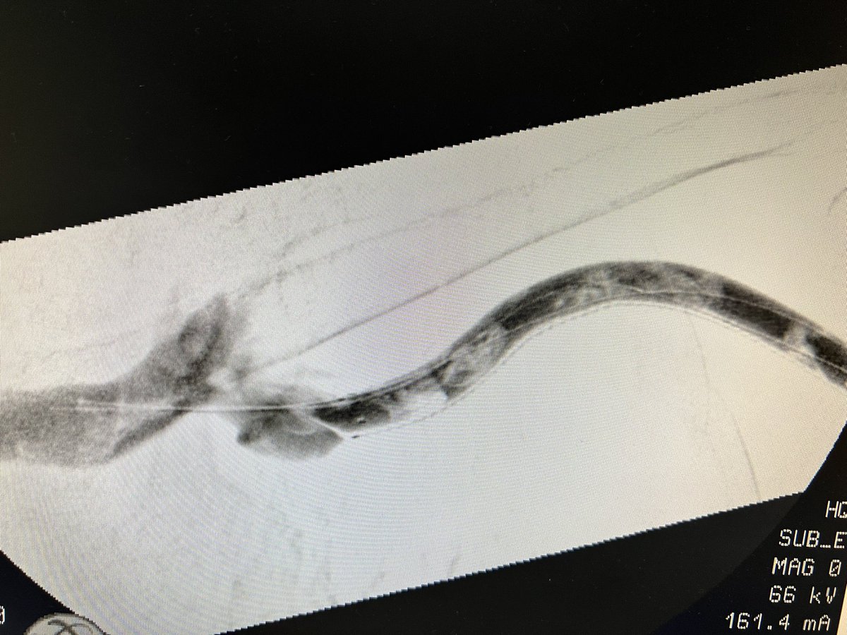 robshahverdyan's tweet photo. Here a case of elsewhere abandoned endoAVF and #BCAVF creation. 2 years later cephalic arch stenosis (SG), occlusion, now subtotal occlusion. Treated with TE, uHPB PTA of whole cephalic vein, &amp; due to significant recoil &amp; residual thrombus/hyperplasia Supera stents. Qa 870ml/min. https://t.co/TwCcvr9LpM