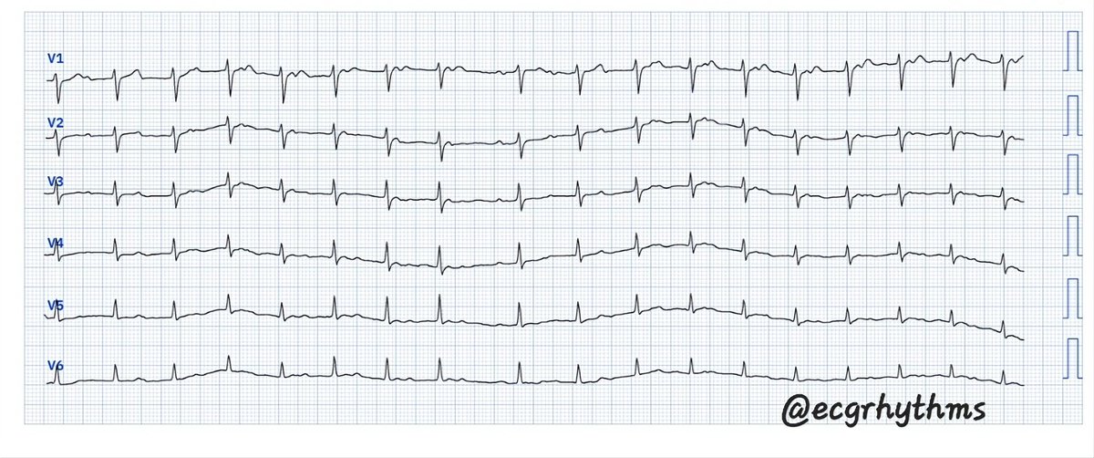 ecgrhythms's tweet photo. From the 📦/ 📧 by 🫂
#BasicECG
Digitized using @PMcardioBot
Difficulty level: ⭐️⭐️⭐️ (out of 5⭐️)
What is your ECG interpretation? Poll next
#MedEd
#MedTwitter
#CardioTwitter
#EPeeps https://t.co/RC6FUiSd7o