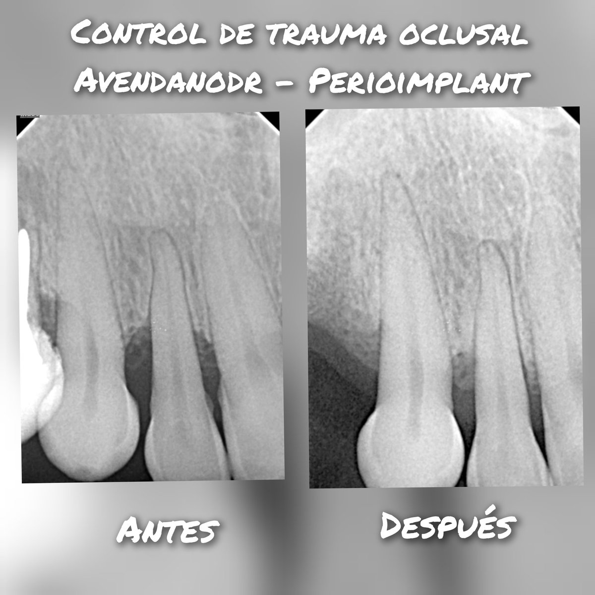 avendanodr's tweet photo. Daily Floss News 408. El trauma oclusal es la lesión a los tejidos periodontales por fuerzas oclusales excesivas. La 1ra. Parte de su manejo: diagnostico, pronóstico y fase inicial periodontal. #mismeetteam, #misimplants, #perioimplant, #avendanodr https://t.co/ES6MWnPpRE