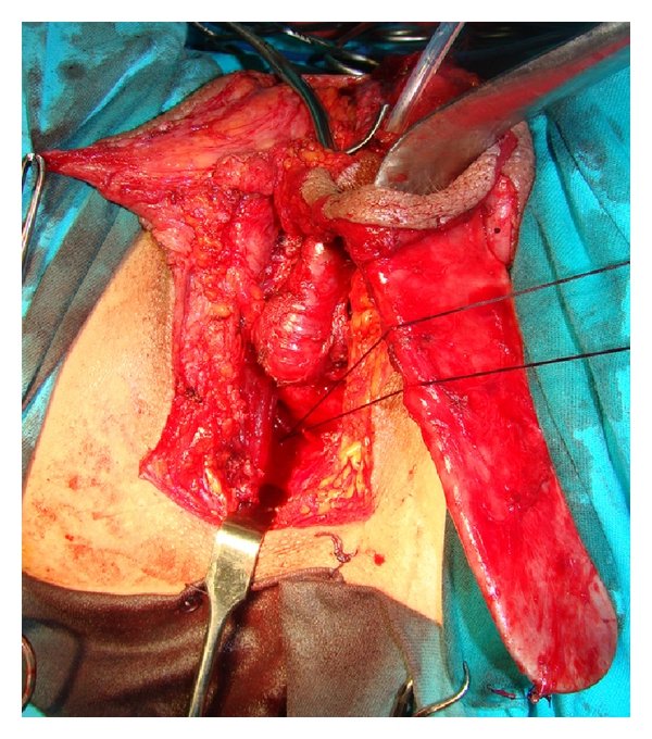 GYerathel's tweet photo. Vaginoplasty

is surgery to create a vagina. It involves removing the penis, testicles and scrotum.

Vaginoplasty involves rearranging tissue in the genital area to create a vaginal canal (or opening) and vulva (external genitalia), including the labia. https://t.co/njGKNmgRt5