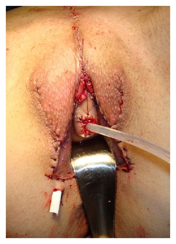 GYerathel's tweet photo. Vaginoplasty

is surgery to create a vagina. It involves removing the penis, testicles and scrotum.

Vaginoplasty involves rearranging tissue in the genital area to create a vaginal canal (or opening) and vulva (external genitalia), including the labia. https://t.co/njGKNmgRt5