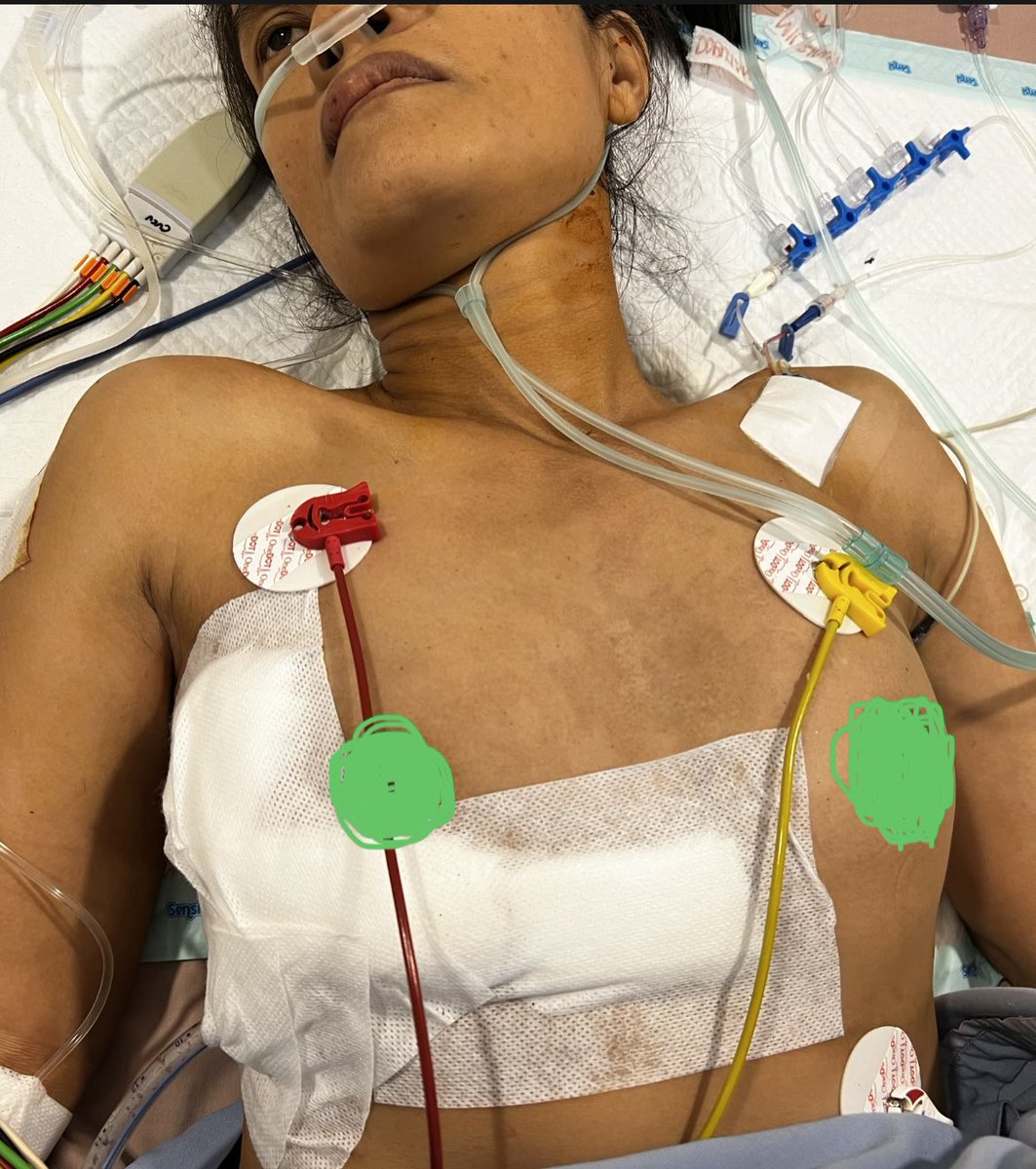 JindanFuad's tweet photo. A 40 y.female with MR severe ,prolaps AML, Infective Endocarditis, flaoting vegetation up n down.We did n urgent MICS MVR n Laa closured.
We extubated her in the OR.
We wished her well and speedy recovery.
#mics #endocarditis #mitralvalvesurgery #awalbros https://t.co/2uR2QqJMG4