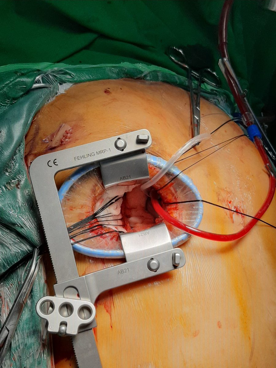 JindanFuad's tweet photo. A 40 y.female with MR severe ,prolaps AML, Infective Endocarditis, flaoting vegetation up n down.We did n urgent MICS MVR n Laa closured.
We extubated her in the OR.
We wished her well and speedy recovery.
#mics #endocarditis #mitralvalvesurgery #awalbros https://t.co/2uR2QqJMG4