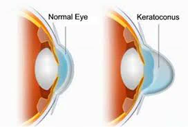Small update, went to get my eyes checked and my doctor said I may have a condition called keratoconus, which could be caused by high blood pressure, diabetes or rubbing of the eye. My glasses come in a couple weeks but the doctor recommends I wear a special contact lens. 