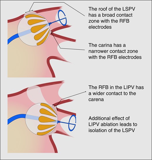 Debbe McCall (@debbemccall) on Twitter photo Efficacy and safety in patients treated with a novel radiofrequency balloon: a two centres experience from the AURORA collaboration bit.ly/3nih4pJ <a href="/bordistef/">Stefano Bordignon, EP</a> @BorisSchmidt5 <a href="/AndreasMetzner7/">Andreas Metzner</a> <a href="/AndreasRillig/">Andreas Rillig</a> <a href="/my_ilaria/">Ilaria My</a> <a href="/dvidschaack/">David Schaack</a>
<a href="/ShaojieChen1/">Shaojie Chen</a> <a href="/jongichun/">Julian Chun</a> Efficacy and safety in patients treated with a novel radiofrequency balloon: a two centres experience from the AURORA collaboration bit.ly/3nih4pJ <a href="/bordistef/">Stefano Bordignon, EP</a> @BorisSchmidt5 <a href="/AndreasMetzner7/">Andreas Metzner</a> <a href="/AndreasRillig/">Andreas Rillig</a> <a href="/my_ilaria/">Ilaria My</a> <a href="/dvidschaack/">David Schaack</a>
<a href="/ShaojieChen1/">Shaojie Chen</a> <a href="/jongichun/">Julian Chun</a>