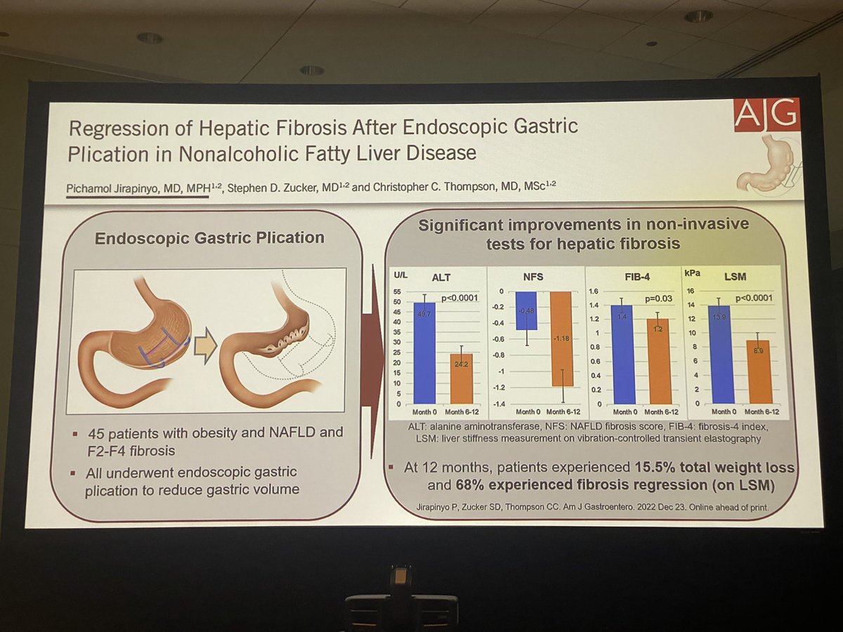 helpatologist's tweet photo. Another fascinating talk showcasing the benefits of POSE for our liver patients by Dr Jirapinyo
#EndoHepatology #EUSPPG #livertwitter #DDW2023 @DDWMeeting https://t.co/NTH96uR5KB
