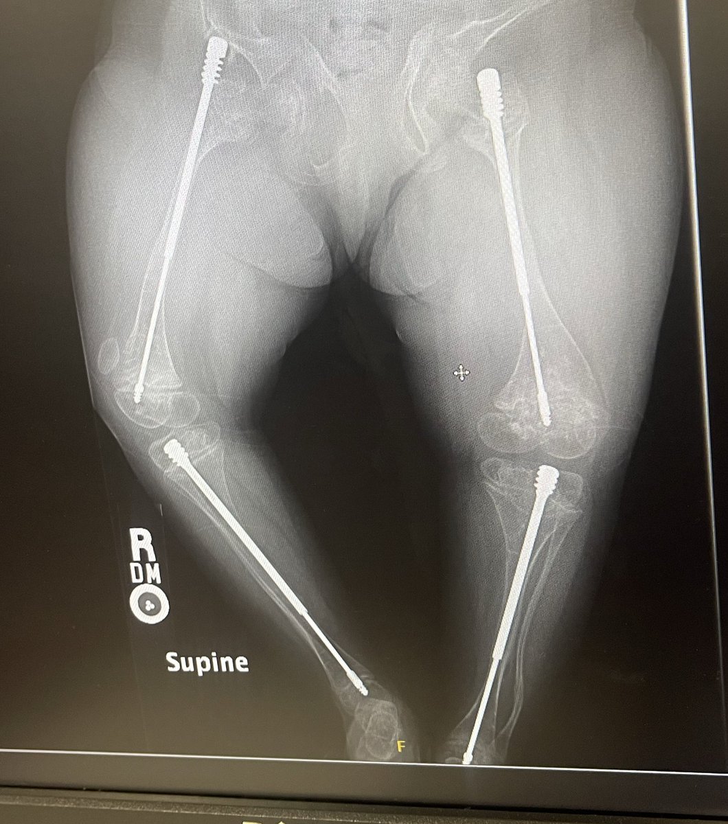 Faisser Duval (FD) nail and Bisphosphonate injections are game changer in treatment of Osteogenesis Imperfecta (OI) #OIawarenessweek #unbreakablespirit #osteogenesisimperfecta #wishboneday #posna