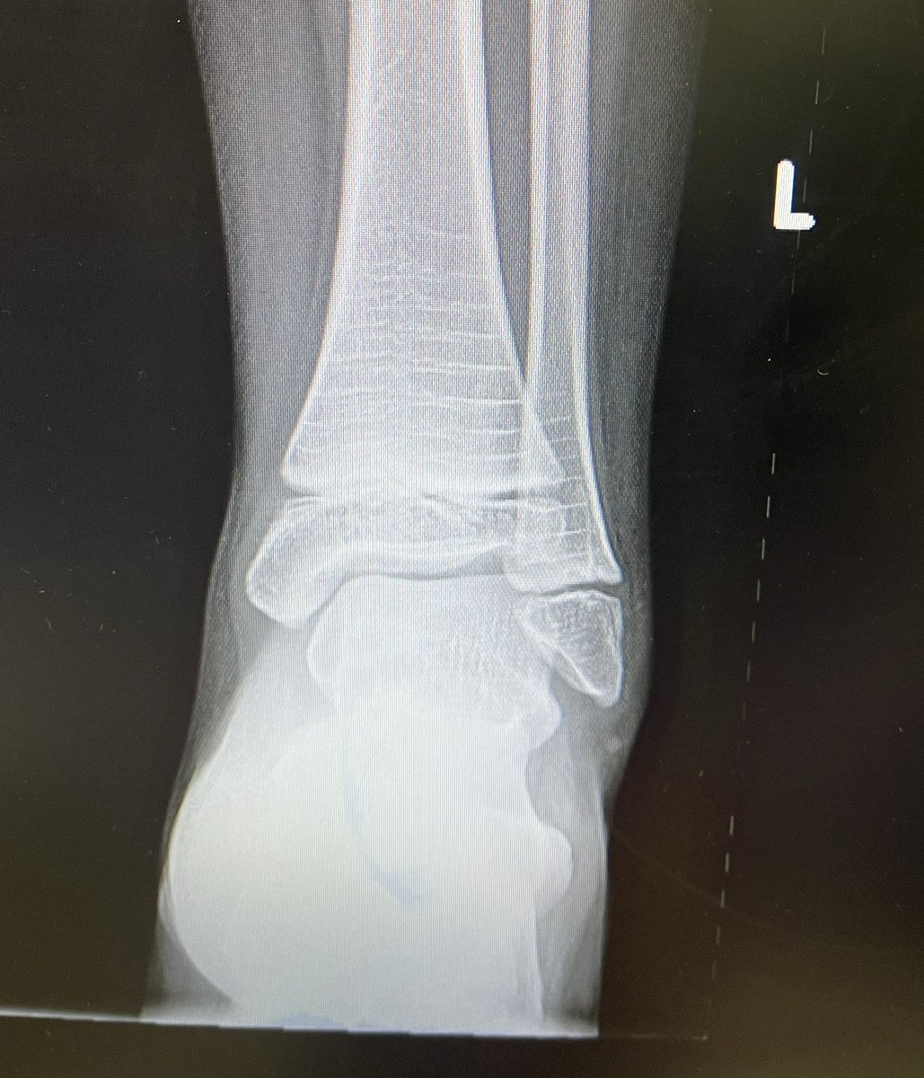 md_thabet's tweet image. Faisser Duval (FD) nail and Bisphosphonate injections are game changer in treatment of Osteogenesis Imperfecta (OI) #OIawarenessweek #unbreakablespirit #osteogenesisimperfecta #wishboneday #posna