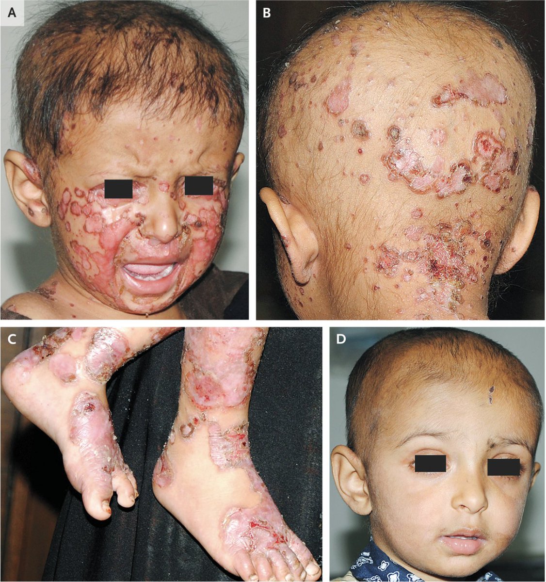 DrEades's tweet photo. From today's NEJM. The kid was diagnosed with a zinc deficiency brought on by his vegetarian parents. Lower left photo after zinc supplementation. Would never have happened had he ben fed meat. https://t.co/krh0X77C7Z