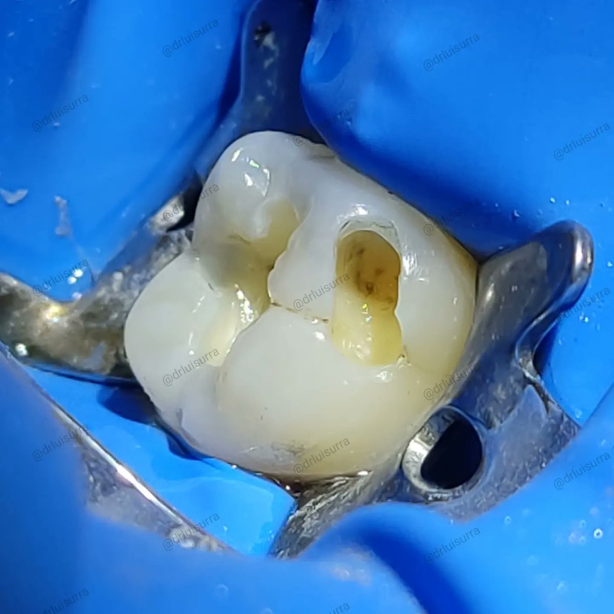 drluisurra's tweet photo. A la paciente le retiraron el 3er molar superior (¿¿??) , cuando ella refería molestia en el 1er molar inferior 🤨. https://t.co/8ilP20zzrB