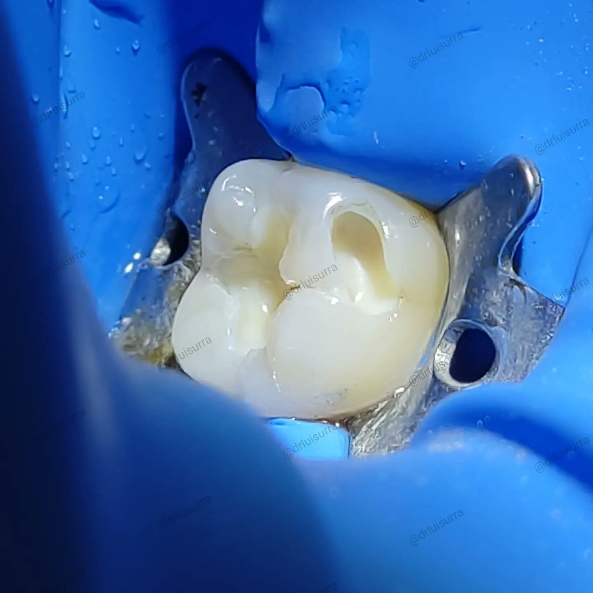 drluisurra's tweet photo. Siempre escuchemos a los pacientes y tratemos de brindar la mejor atención posible. 🤘🤘🤘
.
.
.
#dentista #odontologia #dientesblancos #dentistry #stunningsmile #cadcam #Irapuato #guanajuato #dentist #endodoncia #rootcanal https://t.co/tup8LKHXe1