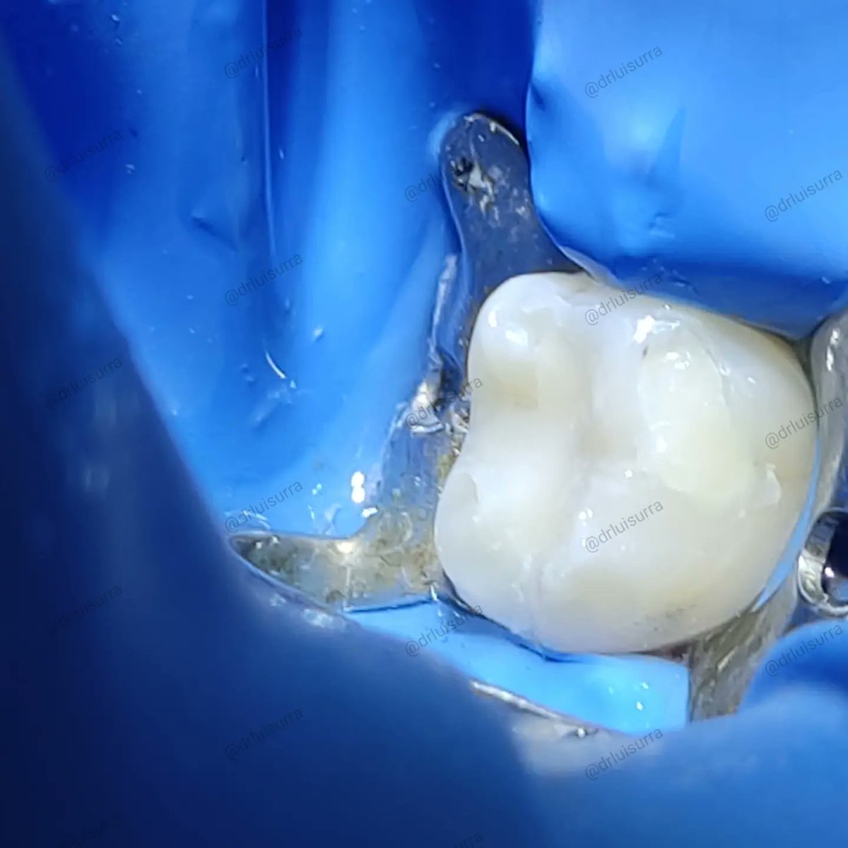 drluisurra's tweet photo. Siempre escuchemos a los pacientes y tratemos de brindar la mejor atención posible. 🤘🤘🤘
.
.
.
#dentista #odontologia #dientesblancos #dentistry #stunningsmile #cadcam #Irapuato #guanajuato #dentist #endodoncia #rootcanal https://t.co/tup8LKHXe1