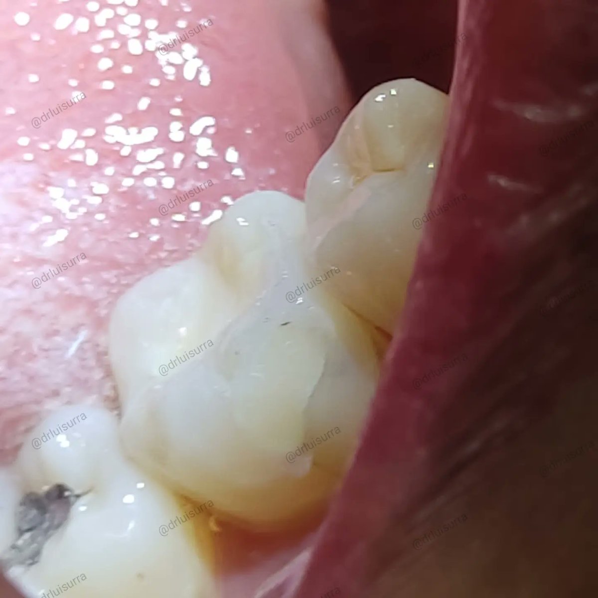 drluisurra's tweet photo. Siempre escuchemos a los pacientes y tratemos de brindar la mejor atención posible. 🤘🤘🤘
.
.
.
#dentista #odontologia #dientesblancos #dentistry #stunningsmile #cadcam #Irapuato #guanajuato #dentist #endodoncia #rootcanal https://t.co/tup8LKHXe1