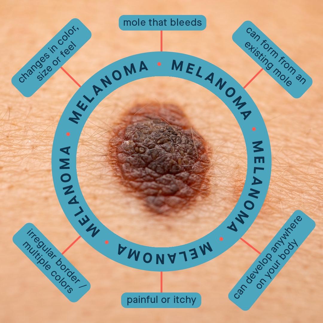 Dr Pimple Popper on Twitter "May is Skin Cancer Awareness Month 🦠 Here