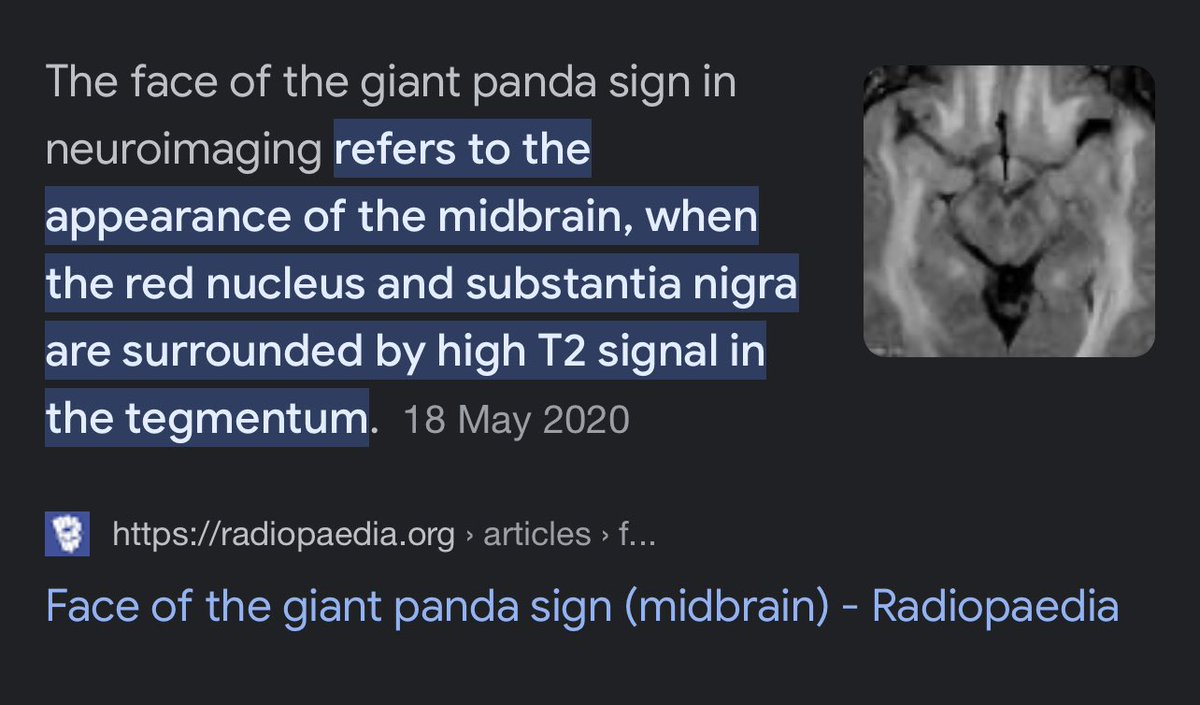 @iruyassu This is the face of the giant panda sign due to copper deposition in the midbrain which leads to tremors and movement disorders. Thanks for sharing! 🐼