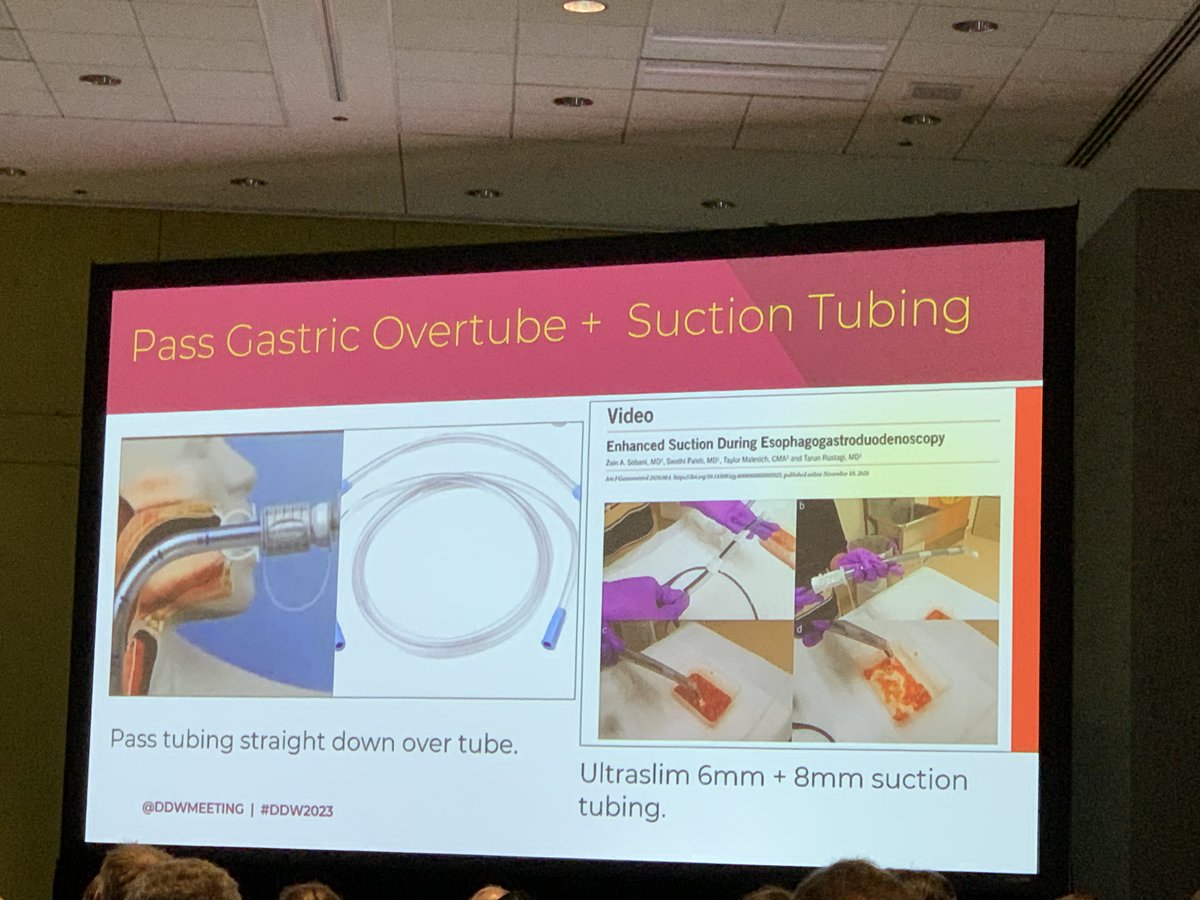 Yale Digestive Diseases (@yaledigestive) on Twitter photo Great #GI 🩸 lecture by <a href="/DrBloodandGuts/">Andy Tau, MD</a> at #DDW with helpful tools and tricks including a tip from our very own <a href="/ZSobaniMD/">Zain A Sobani MD</a> published in <a href="/AmJGastro/">AJG - The American Journal of Gastroenterology</a> Great #GI 🩸 lecture by <a href="/DrBloodandGuts/">Andy Tau, MD</a> at #DDW with helpful tools and tricks including a tip from our very own <a href="/ZSobaniMD/">Zain A Sobani MD</a> published in <a href="/AmJGastro/">AJG - The American Journal of Gastroenterology</a>