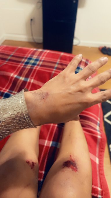 Sooooo this happened  It hurts soooo bad https://t.co/jvNItinGnF<a href="/tag/transexual"class="tags"><span>#transexual</span></a><a href="/tag/pornstar"class="tags"><span>#pornstar</span></a><a href="/tag/girlslikeus"class="tags"><span>#girlslikeus</span></a><a href="/tag/jessydubai"class="tags"><span>#jessydubai</span></a>