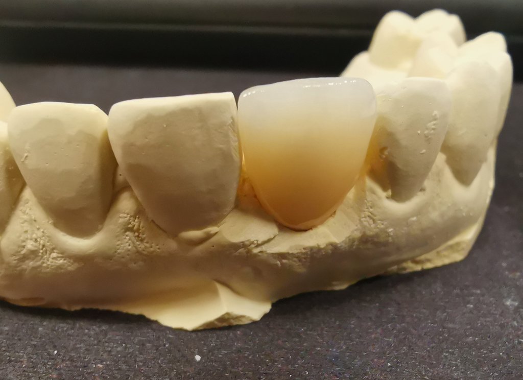 A3 stained cervical A2 incisal E-max crown made by 'khalid' #waxup #dentalart #aestheticdentistry #cosmeticdentistry #dental  #dentalcare #dentalphotography #dentalstudent #dentist #dentista #dentistlife #dentistry #dentistrylife #dentistrylove #dentistrymyworld