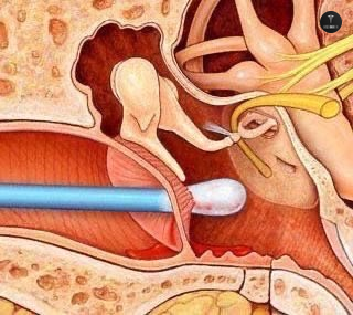 BaseAnakFK's tweet photo. Jangan lagi pakai cottonbud buat korek kuping ya guys, kemarin dapat pasien yang kapasnya ketinggalan di dalam banget😭 Pasien baru sadar 1 minggu kemudian setelah kupingnya infeksi bernanah dok 😭 https://t.co/hZq30hYthK