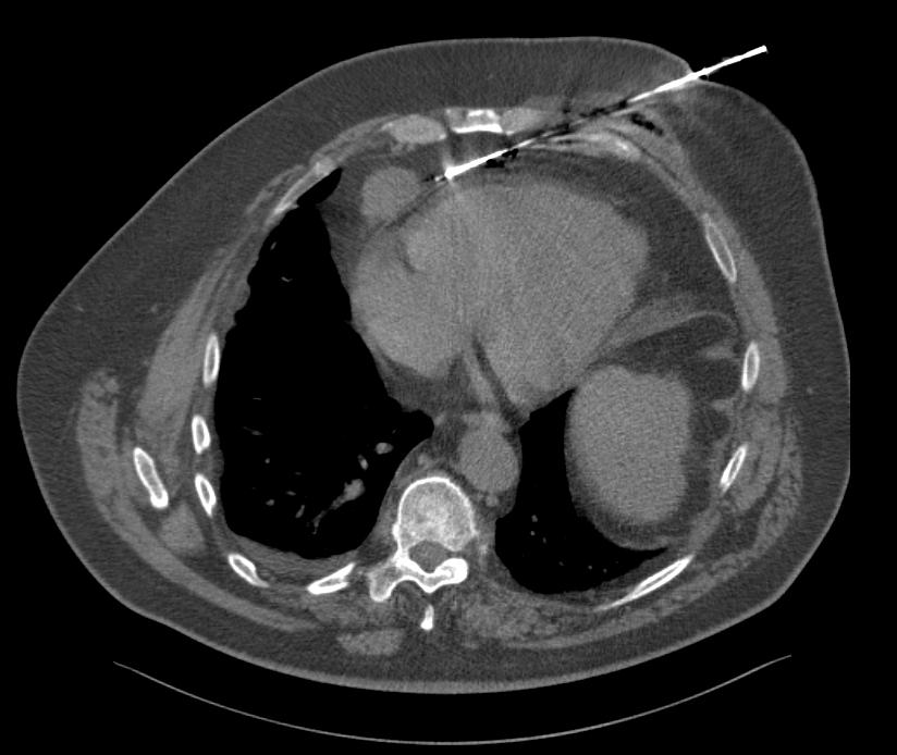 Biopsja gruboigłowa pod kontrolą TK podejrzanej zmiany położonej kilka milimetrów od serca. Wynik - przerzut mięsaka. Zabieg w znieczuleniu miejscowym.  #biopsja #onkologiainterwencyjna #radiologiainterwencyjna #CTguidedbiopsy #sarcoma #miesak