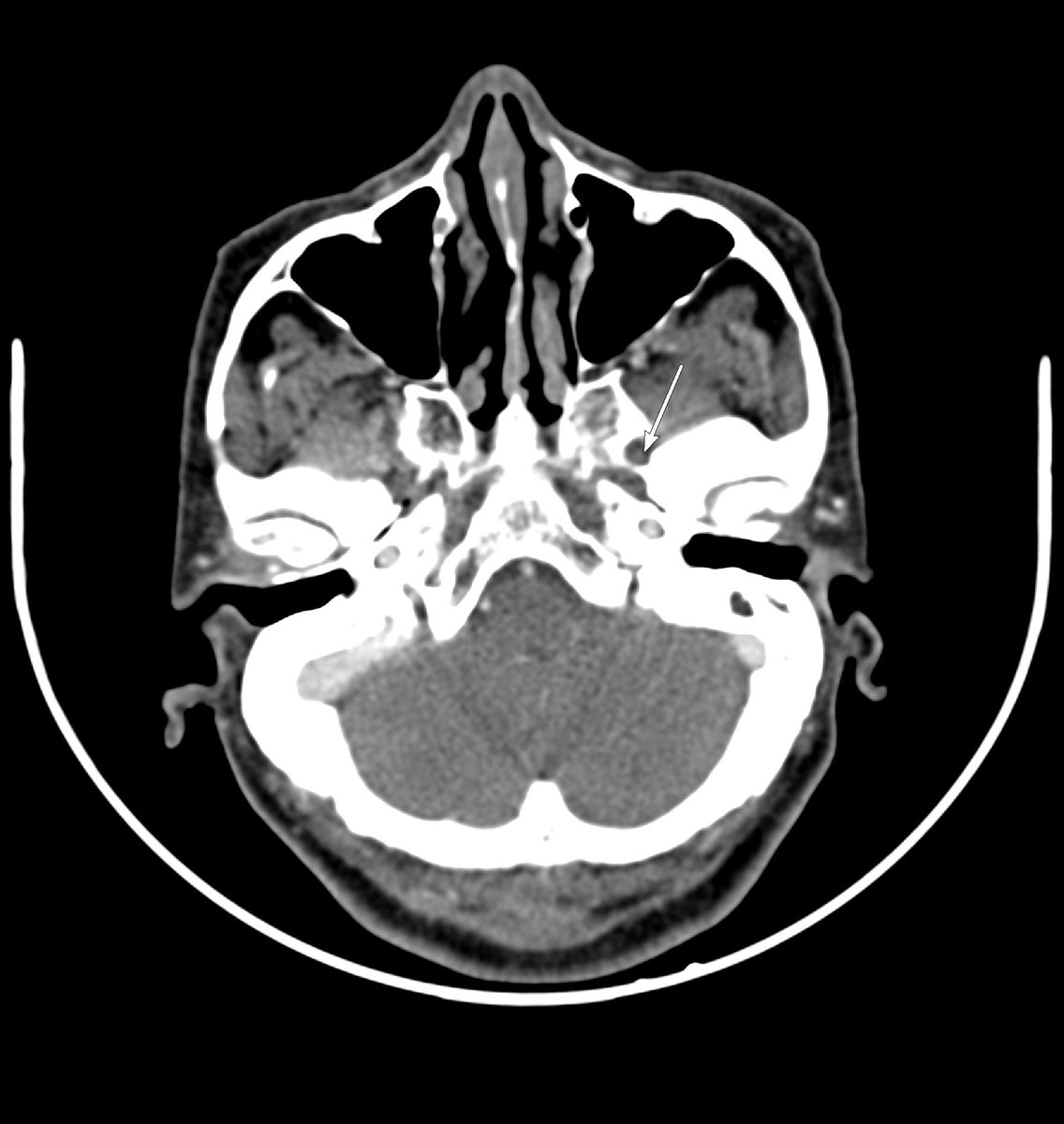 Case of Ca buccal mucosa. Identify the structure and finding (arrow). @FOAMrad @Med_FOAMed @radRounds @RadiologySigns @RADSign #Neurotwitter