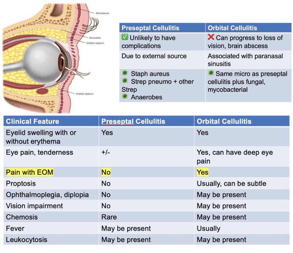 PERIORBITAL VS. ORBITAL CELLULITIS 👁️ 

#FOAMed #PEM #MedEd #MedTwitter #Emergency #FOAped #residents #Students #medicaleducation #medicalstudent
#pediamed #NICU #PICU #icu #CriticalCare #pediatwitter #pediatricians