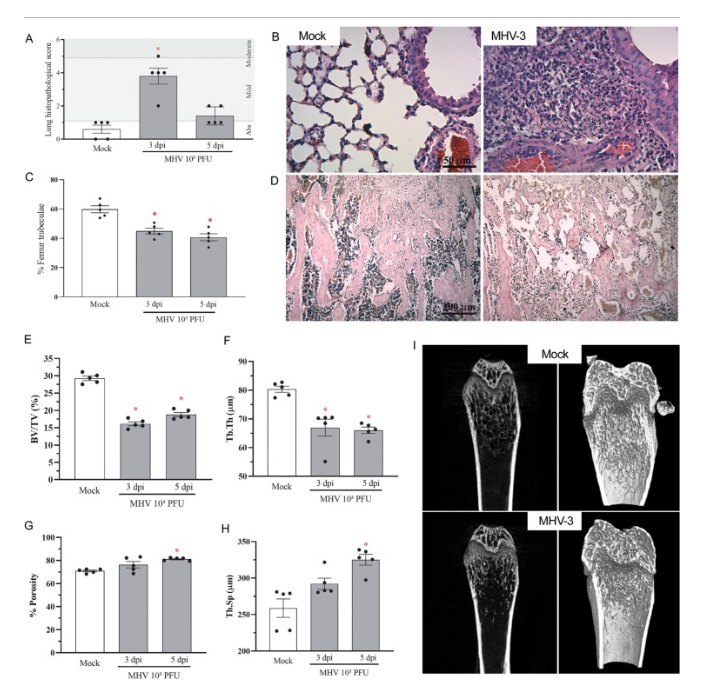 HarrySpoelstra's tweet photo. More evidence for possible post-Covid19 Skeletal damage: Bone resorption #LongCovid
➡️TNF is a key mediator to trigger osteoclast formation in the context of COVID-19. TNF and IL-1β release induced by Sars-CoV-2 can amplify the pro-inflammatory cascade in the skeletal system to increase the pro-osteoclastogenic milieu.
➡️This study shows that the coronavirus MHV-3 induces an osteoporotic phenotype in mice by triggering an inflammatory environment dependent on TNF in the bone and potentially stimulating the differentiation of osteoclasts through infection of macrophages
CC: @Alitis__ @white_bite @NjbBari3 @CarlvKeirsbilck @DavidJoffe64 @lisa_iannattone @ejustin46 @fitterhappierAJ @MeetJess @dfocosi @TRyanGregory @C_A_Gustave
https://t.co/82w7WDe7Hq