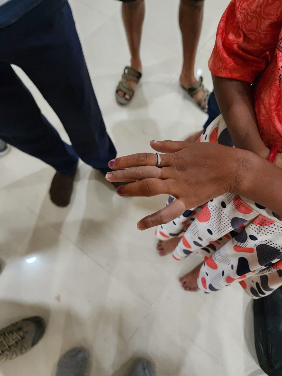 SSEPD2's tweet image. G . Priyambada Mahanta from Keonjhar District fitted with cosmetic silicon fingers with accuracy of nail, colour &amp;amp; size by RCDR, Sambalpur.
@CMO_Odisha @Ashokpandabbsr 
#Sambalpur
#Keonjhar
#Prosthesis
#DisabilityCare
#DisabilityRights 
#OdishaCares