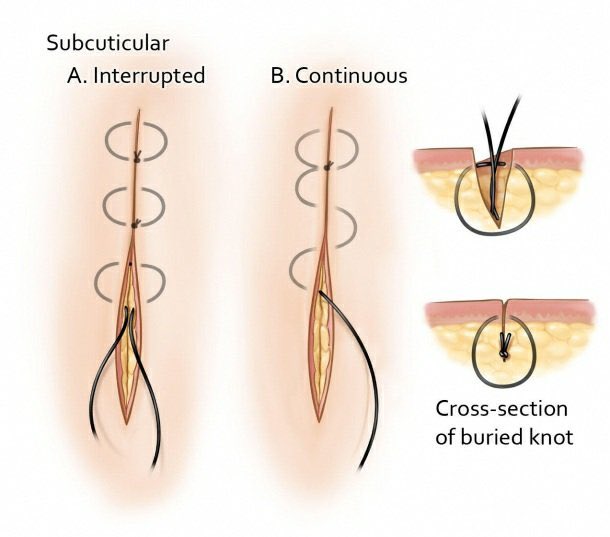 PipeCabreraV's tweet photo. Continuous subcuticular suture: how to do it ⤵️💡💥🪢! A must know for med students 🧑‍🏫 🥼in their surgical clerkship ! #SoMe4Surgery @pferrada1 @SWexner @juliomayol @Cirbosque @TomVargheseJr @rbarbosa91 @NeilFlochMD @LiangRhea https://t.co/CsNk6o0pG5
