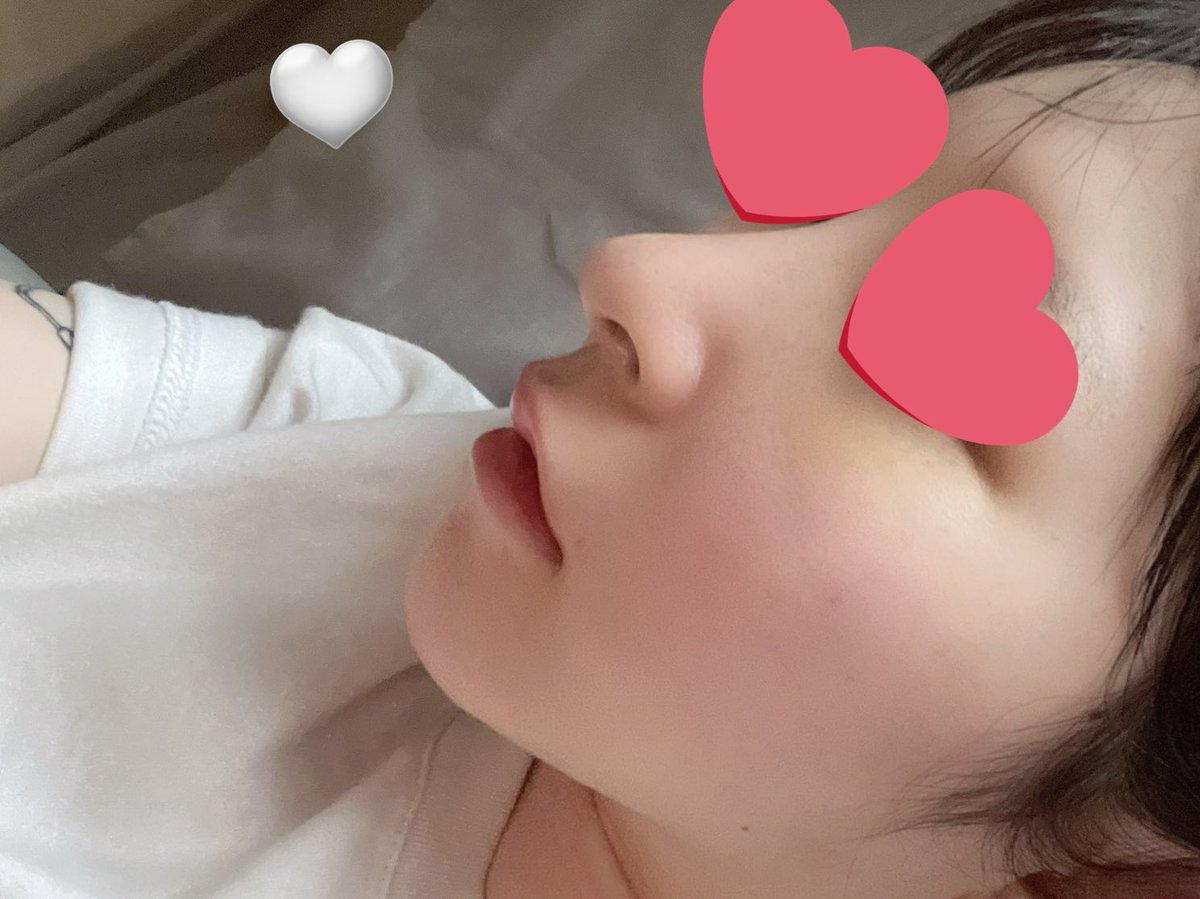 99O1O1's tweet photo. 明後日で3週間👃💕
これ先週撮ったやつだけどアザももう化粧で隠れるし落ち着いてきた〜！毎日煙草に怯えて生きてる🥺 https://t.co/ZNzdYDtnAr