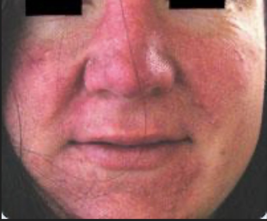 Journal of Brown Hospital Medicine on Twitter "A 30yearold woman