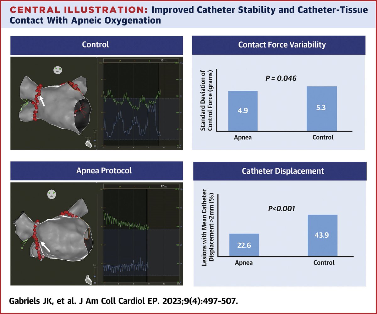 JACCJournals's tweet image. In the #EPLab with #JACCCEP:

Drs. @JamesGabriels, @DrJCheungEP, &amp;amp; team find that a novel strategy of #PVI during #apneic oxygenation results in improved catheter stability &amp;amp; decreased #AFib #ablation times without adverse events. bit.ly/3NE7esQ

#epAblation #EPeeps