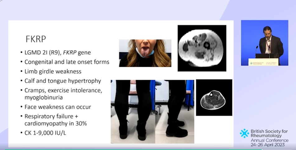 debaditya_roy's tweet photo. 💫#BSR23 #Myositis #IIM #Myositis_Mimickers
☀️#Lovely session by Dr. James Lilleker
🐴While seeing the Horses..
..Lets learn to look at the Zebra!🦓
⛳️Family History Important!
⛳️Imaging & response to Steroids can be deceiving!
⛳️CPK ⬆️⬆️⚠️!
⛳️Beware of these #Red_flags!👇 https://t.co/kyaKPlUA0q