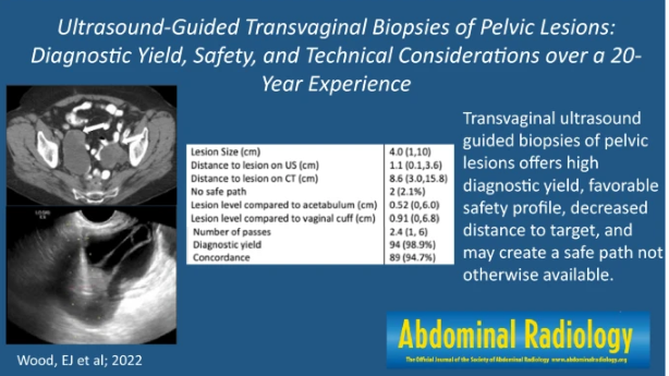 Abdominal Radiology (@abdominal_rad) on Twitter photo Graphic abstract published 1/24/2023 #abdradJ
US-guided transvaginal biopsies of pelvic lesions: diagnostic yield, safety profile, and technical considerations over a 20-year experience
Wood, Pickhardt, Elissa, Gettle & Lubner
<a href="/MankowskiGettle/">Lori Mankowski Gettle,MD,MBA</a>
link.springer.com/article/10.100โฆ Graphic abstract published 1/24/2023 #abdradJ
US-guided transvaginal biopsies of pelvic lesions: diagnostic yield, safety profile, and technical considerations over a 20-year experience
Wood, Pickhardt, Elissa, Gettle & Lubner
<a href="/MankowskiGettle/">Lori Mankowski Gettle,MD,MBA</a>
link.springer.com/article/10.100โฆ